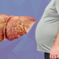 Fatty Liver Treatment: ఫ్యాటీ లివర్ చికిత్సలో కొత్త ఆశ.. వెగోవీ ఇంజెక్షన్‌కు CDSCO ఆమోదం