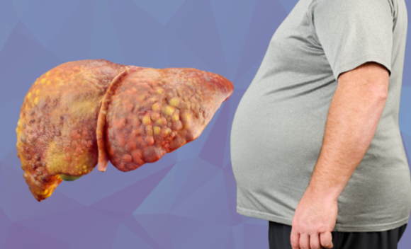 Party Fatty Liver Treatment: ఫ్యాటీ లివర్ చికిత్సలో కొత్త ఆశ.. వెగోవీ ఇంజెక్షన్కు CDSCO ఆమోదం